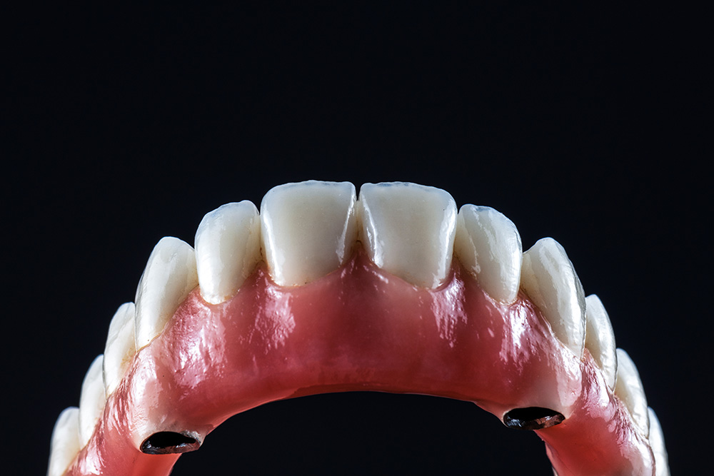 Komplexe Full-Arch-Restauration für eine umfassende Implantatversorgung von Gosemann Dental.