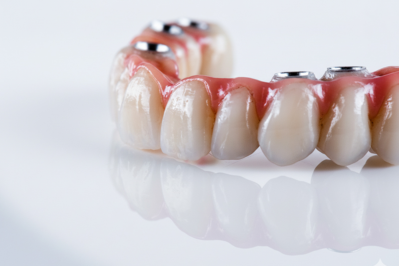 Umfassende Implantatprothetik in Berlin: Eine Full-Arch-Restauration.